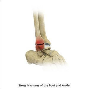 Stress Fractures of Foot and Ankle