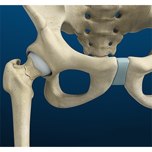 Stress Fractures of the Hip