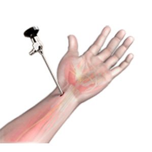 Wrist Arthroscopy