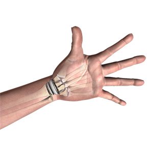 Wrist Joint Replacement