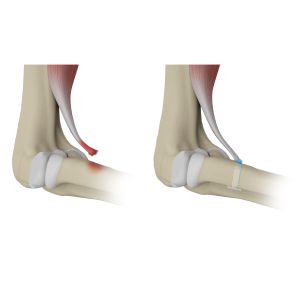 Distal Biceps Avulsion Sp