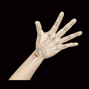 Distal Radius Fracture Sp
