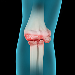 Elbow Arthritis Sp
