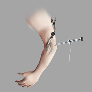 Elbow Arthroscopy Sp