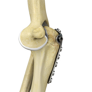 Elbow Fracture Reconstruction Sp