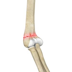 Elbow Fracture Sp