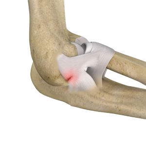 Elbow Sports and Ligament Injuries Sp