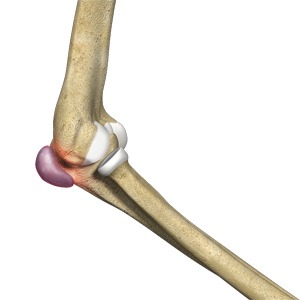 Elbow Trauma Sp