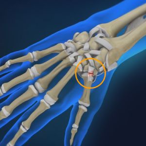 Hand and Wrist Sports and Ligament Injuries Sp