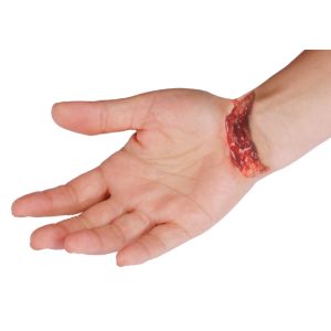 Hand Trauma and Lacerations Sp