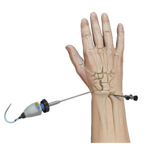 Minimally Invasive Hand and Wrist Surgery Sp