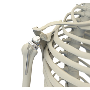 Reverse Shoulder Replacement Sp