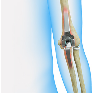 Revision Elbow Replacement Sp