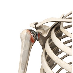 Revision Shoulder Replacement Sp