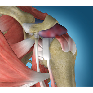 Shoulder Impingement Sp