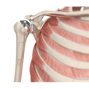 Shoulder Joint Replacement Sp
