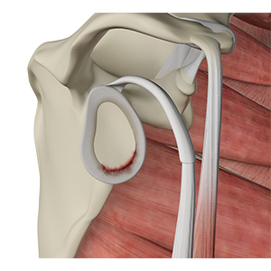 Shoulder Labral Tear Sp