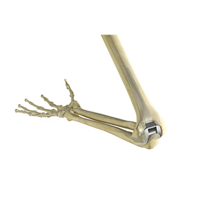Total Elbow Replacement Sp