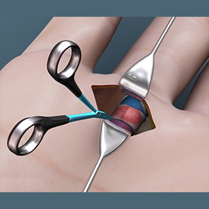 Trigger Finger Release Sp