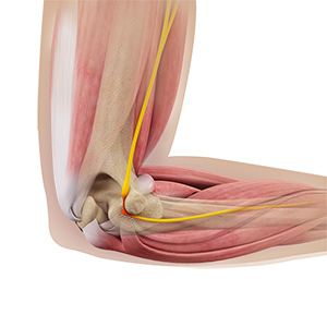 Ulnar Nerve Release Sp
