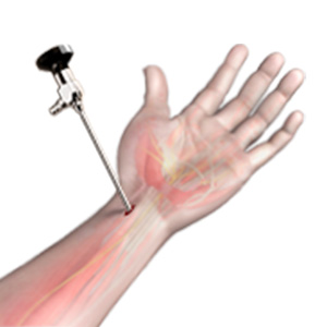 Wrist Arthroscopy Sp