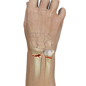 Wrist Fracture Sp