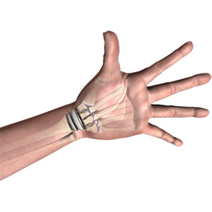 Wrist Joint Replacement Sp