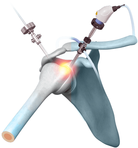Shoulder Arthroscopy