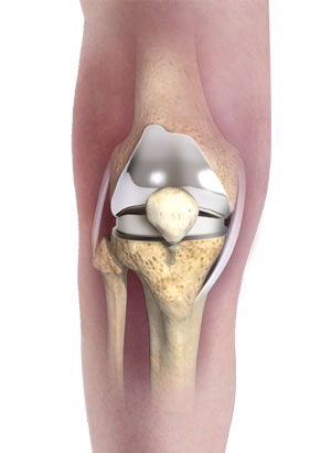 Primary Knee Replacement pic