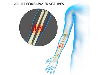 Adult Forearm Fractures - Educational Photo