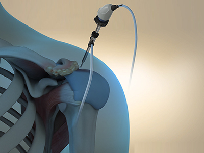 Arthroscopic Surgery - Educational Photo