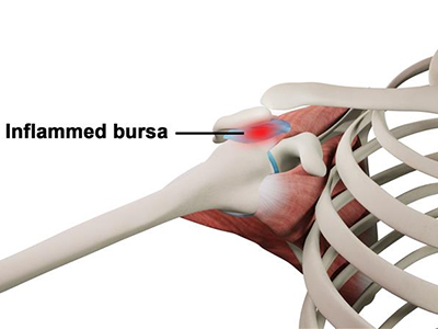 Bursitis - Educational Photo