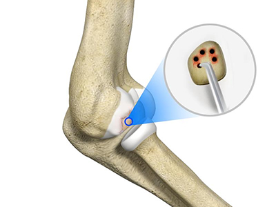 Cartilage Restoration - Educational Photo