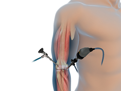 Elbow Arthroscopy - Educational Photo