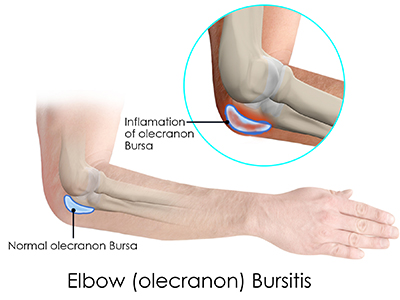 Elbow Bursitis - Educational Photo