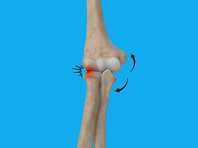 Elbow Impingement - Educational Photo