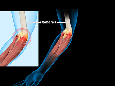 Elbow Sprain - Educational Photo
