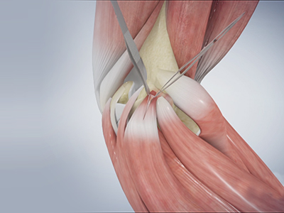 Golfer's Elbow Surgery - Educational Photo