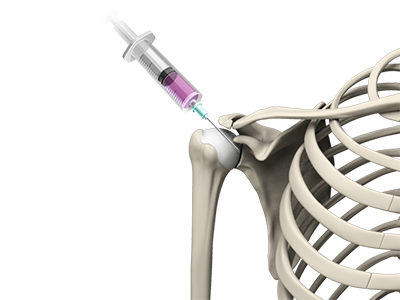 Intra-Articular Joint Injections - Educational Photo