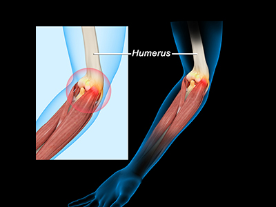 Musculoskeletal Injuries - Educational Photo