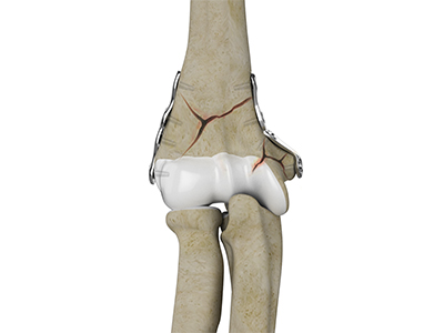 ORIF of Humerus Fractures - Educational Photo