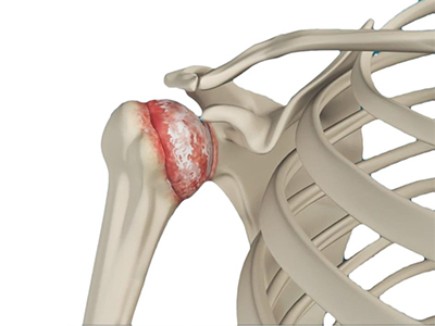 Osteoarthritis - Educational Photo