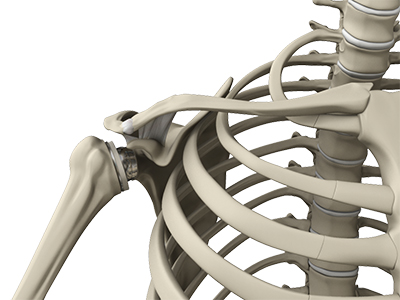 Reverse Shoulder Replacement - Educational Photo