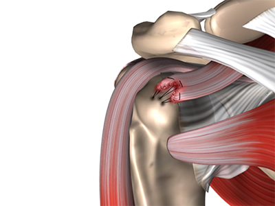 Rotator Cuff Repair - Educational Photo