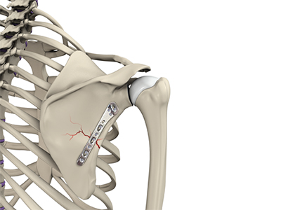 Shoulder Fracture Care - Educational Photo