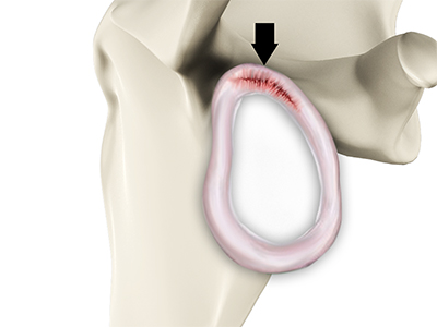 SLAP Tears - Educational Photo