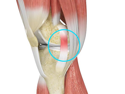 Sprains and Strains - Educational Photo