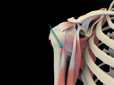 Tendonitis - Educational Photo