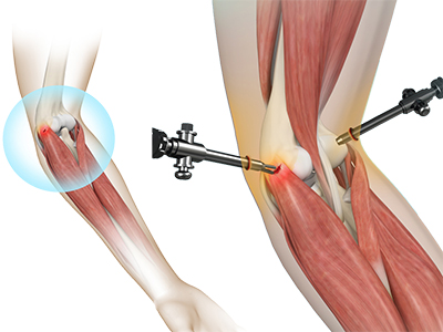 Tennis Elbow Surgery - Educational Photo