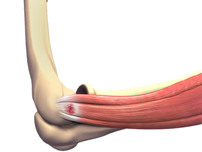Tennis Elbow - Educational Photo
